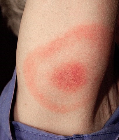 What is a Gonorrhoea rash?